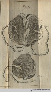 Figure 5, Number 1 shows a placenta for a single infant. Number 2 shows a placenta for twins.
