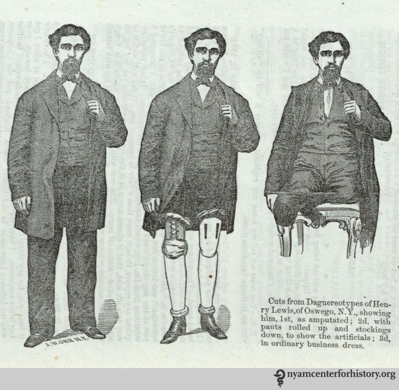 Amputated, in stockings, and pants rolled up to show the artificials. On page 24 of Douglas Bly's ""A new and important invention," 1862.