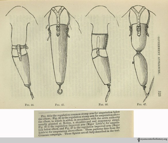 Regulation common stump arms. In Henry Heather Bigg, Artificial Limbs and Amputations, 1889, p. 122 and 123.