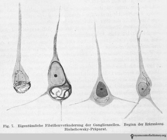Drawings of histological preparations of Auguste D’s material, stained by Bielschowsky’s technique to demonstrate tangles, and their stages. Beginning of the disease. In Alzheimer, Ueber eigenartige Krankheitsfaelle des spaeteren Alters [On peculiar cases of disease at higher age]. Zeitschrift fuer die gesamte Neurologie und Psychiatrie 1911;4:356-385. 