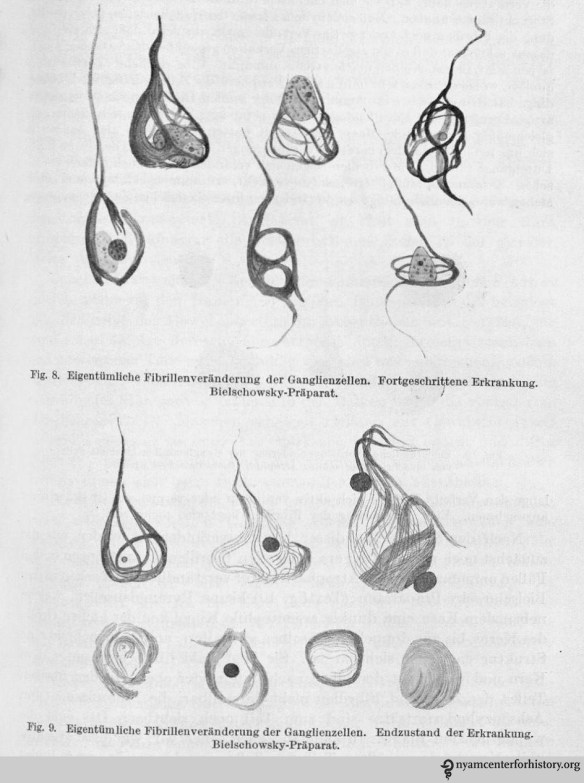 Drawings of histological preparations of Auguste D’s material, stained by Bielschowsky’s technique to demonstrate tangles, and their stages. 8. Advanced stage; and 9. Terminal state of the disease.. In Alzheimer, Ueber eigenartige Krankheitsfaelle des spaeteren Alters [On peculiar cases of disease at higher age]. Zeitschrift fuer die gesamte Neurologie und Psychiatrie 1911;4:356-385.